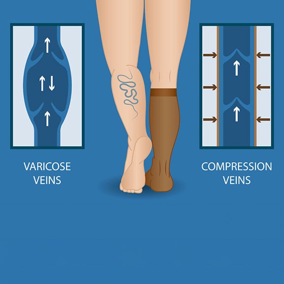 compression-stockings-2